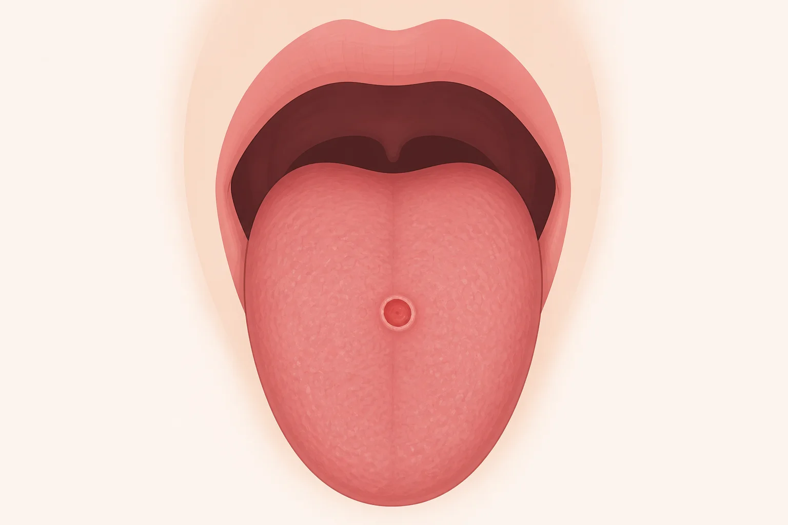 Medical illustration of a syphilis chancre on the surface of a tongue
